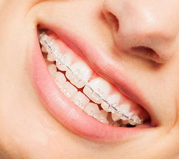 Spring Clear Braces