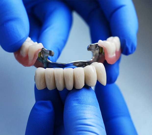 Spring Dental Bridges