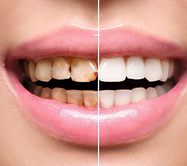 Spring Dental Implant Restoration