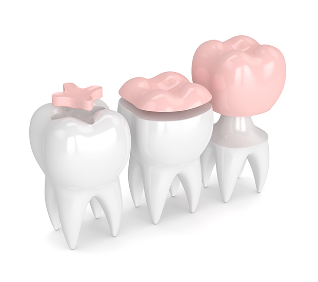 Spring Dental Inlays and Onlays