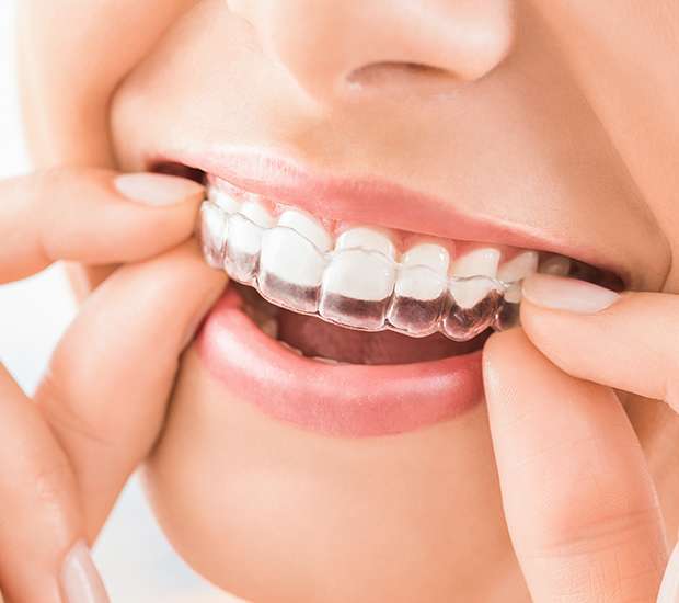 Spring Does Invisalign Really Work
