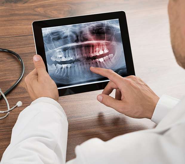 Spring Types of Dental Root Fractures