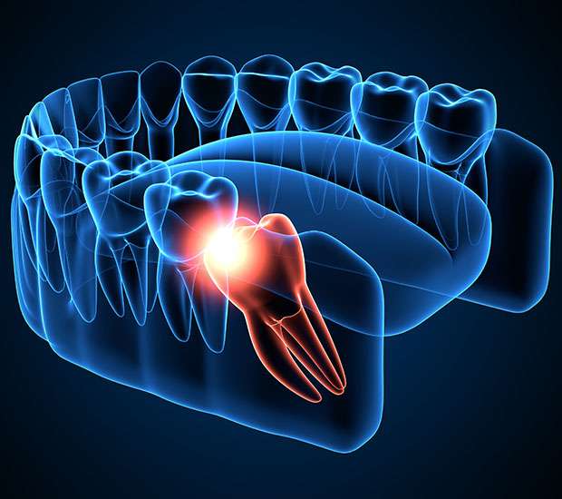Spring Wisdom Teeth Extraction